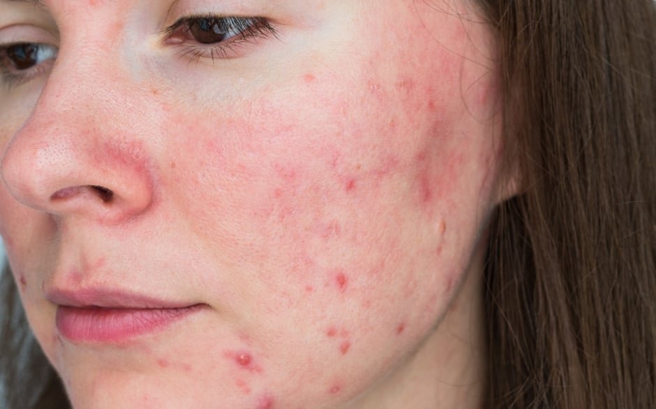 Paroxetine Targets Neurovascular-Immune Pathways in Rosacea
