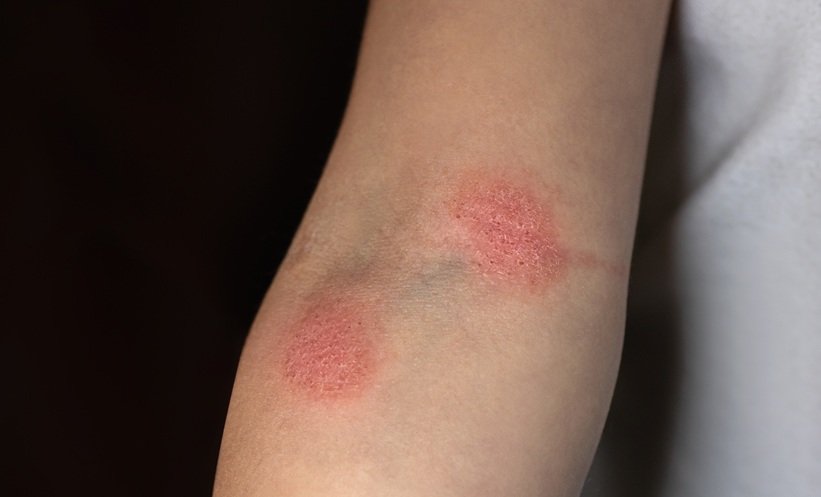 Hypopigmented Mycosis Fungoides Shows Low Risk