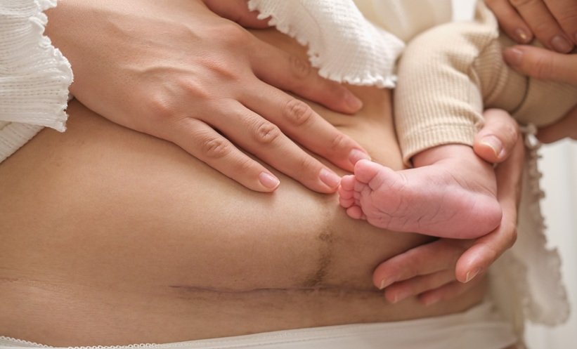 Full-Dilation Caesarean Linked Higher Risk of Preterm Birth