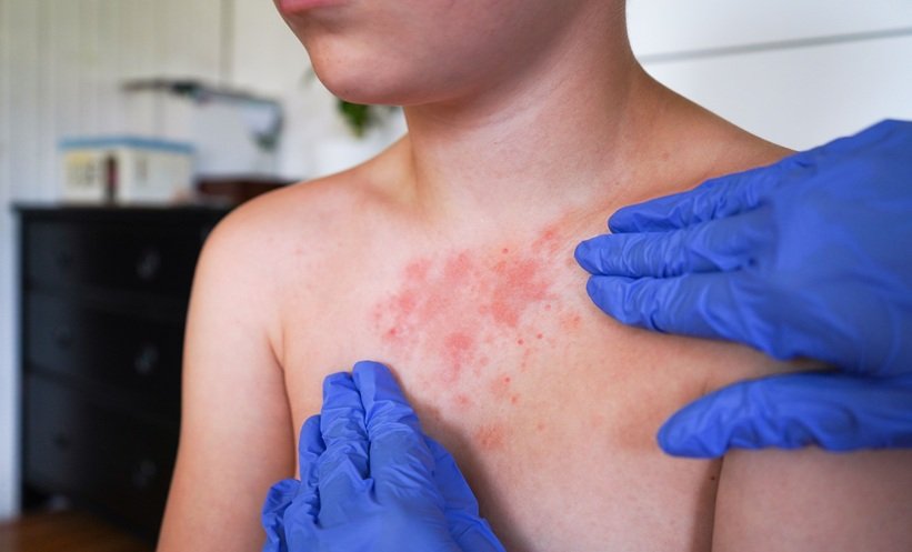 Antibiotic Allergy Testing De-labels Most Children